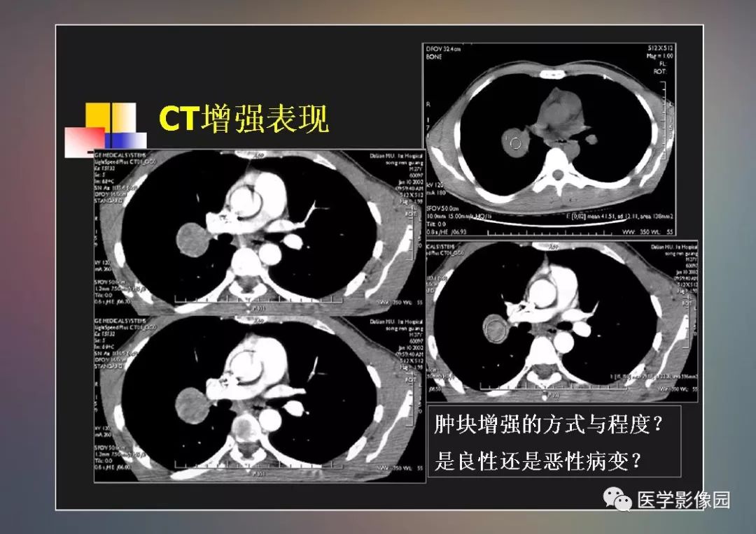 【PPT】右肺门区类圆形肿物的鉴别诊断—病例分析