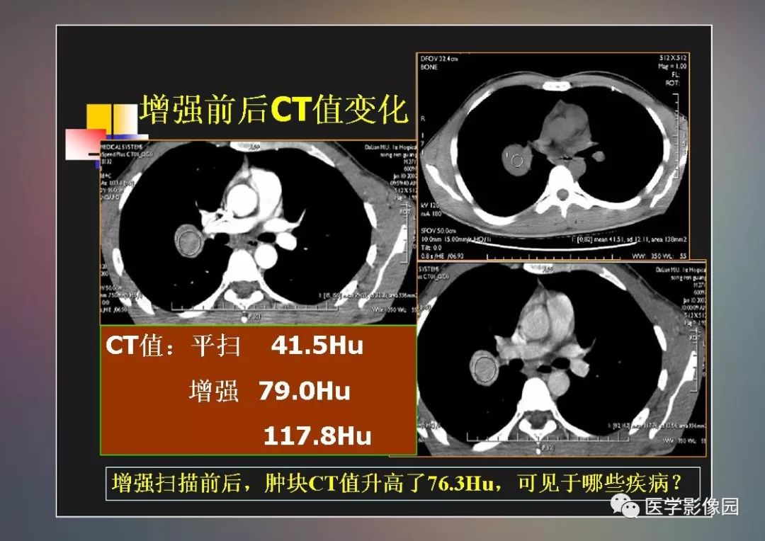【PPT】右肺门区类圆形肿物的鉴别诊断—病例分析
