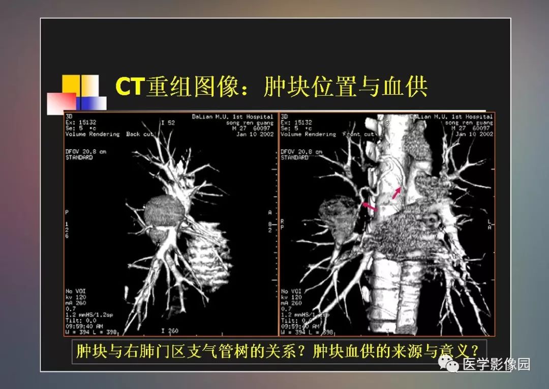 【PPT】右肺门区类圆形肿物的鉴别诊断—病例分析