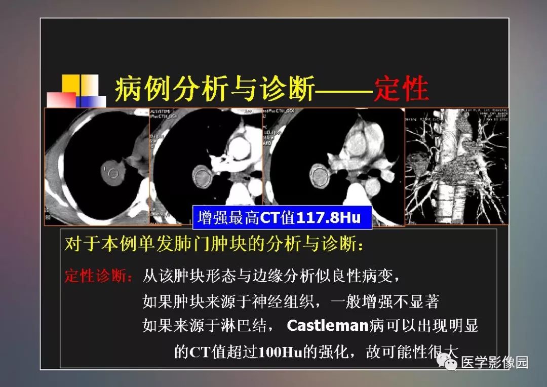【PPT】右肺门区类圆形肿物的鉴别诊断—病例分析