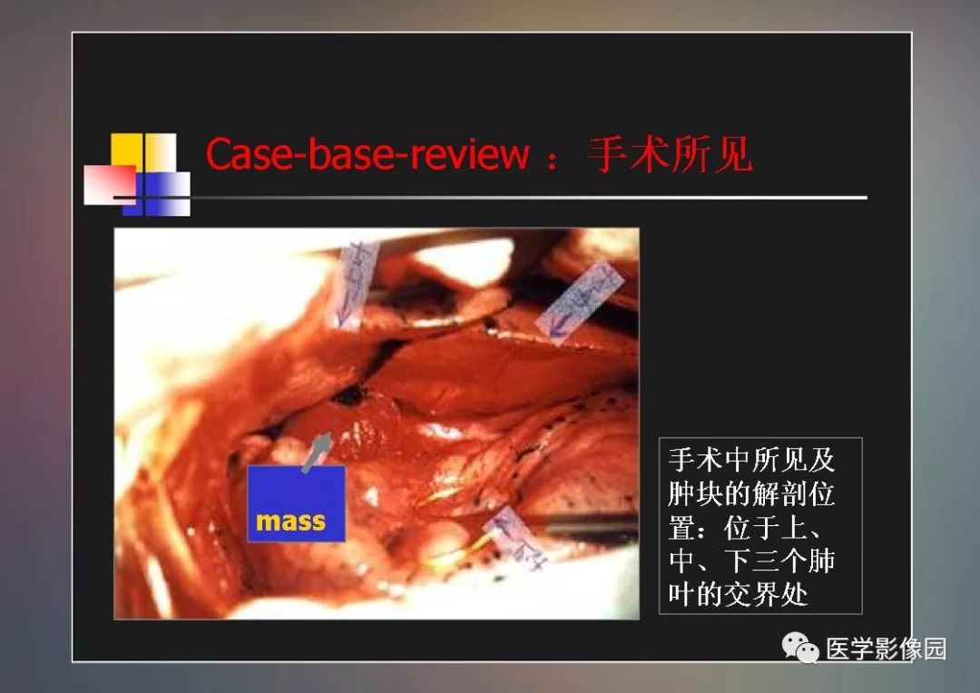 【PPT】右肺门区类圆形肿物的鉴别诊断—病例分析