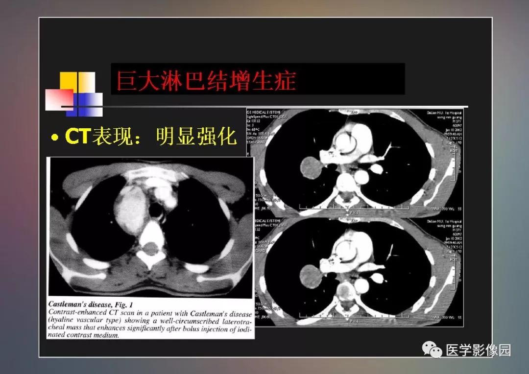 【PPT】右肺门区类圆形肿物的鉴别诊断—病例分析