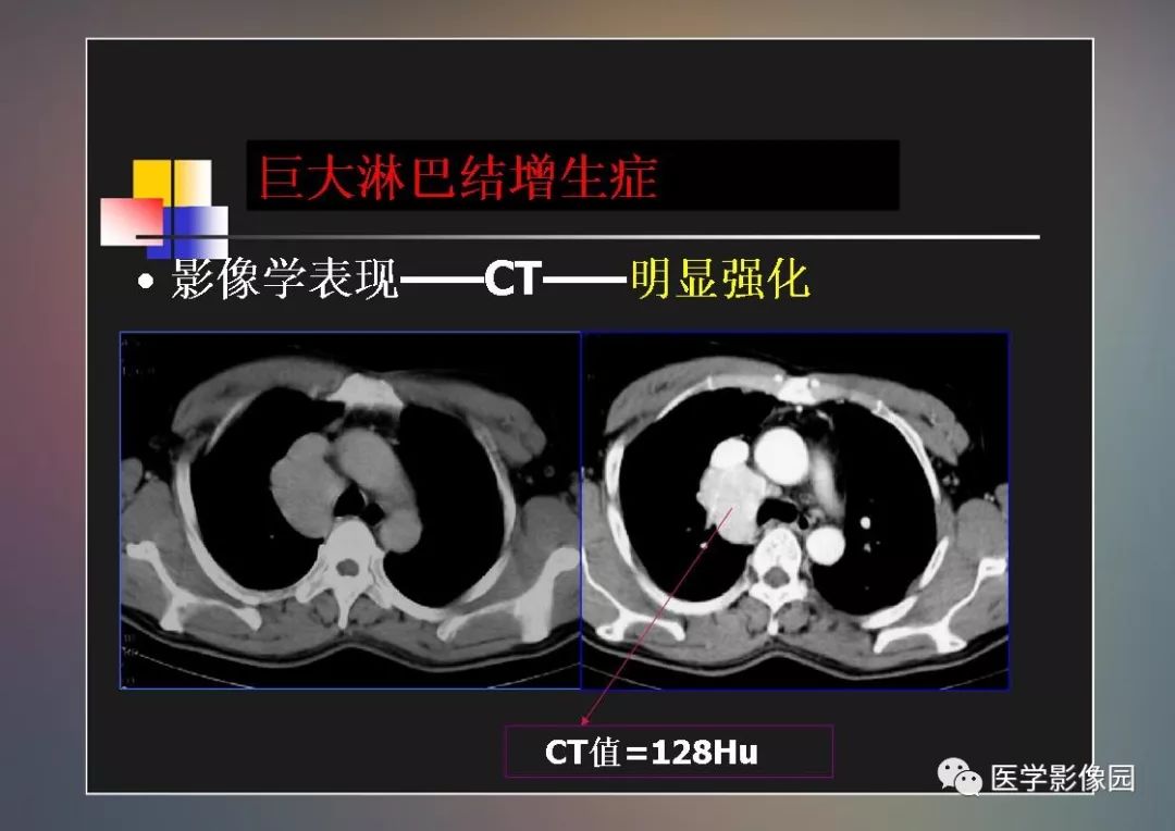 【PPT】右肺门区类圆形肿物的鉴别诊断—病例分析
