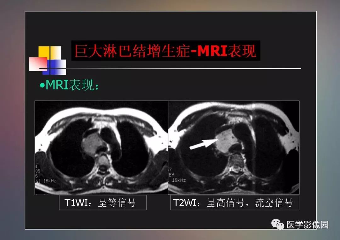 【PPT】右肺门区类圆形肿物的鉴别诊断—病例分析