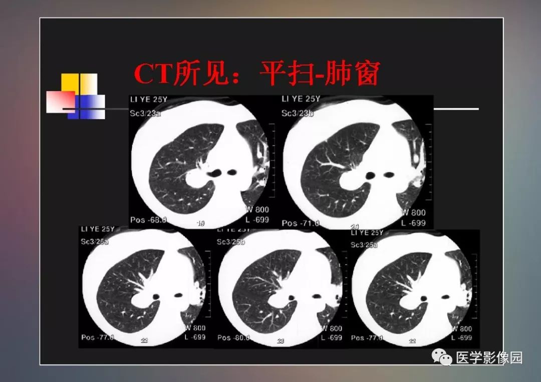 【PPT】右肺门区类圆形肿物的鉴别诊断—病例分析
