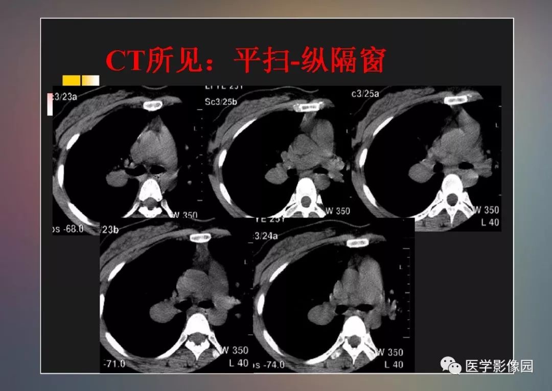 【PPT】右肺门区类圆形肿物的鉴别诊断—病例分析