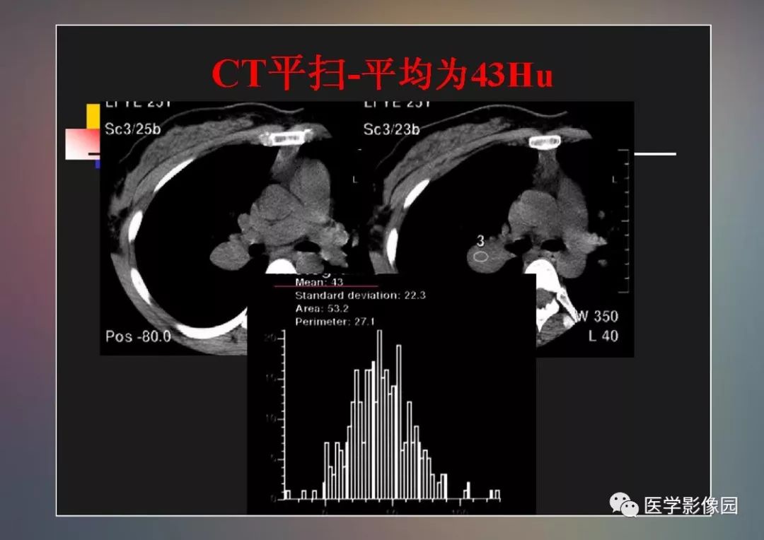 【PPT】右肺门区类圆形肿物的鉴别诊断—病例分析