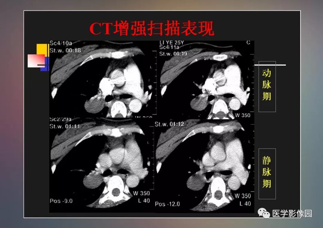 【PPT】右肺门区类圆形肿物的鉴别诊断—病例分析