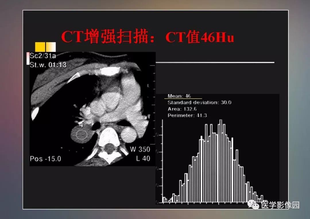 【PPT】右肺门区类圆形肿物的鉴别诊断—病例分析