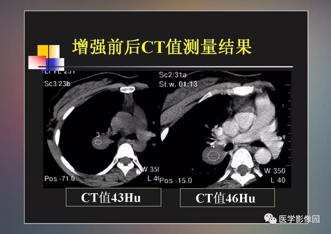 【PPT】右肺门区类圆形肿物的鉴别诊断—病例分析