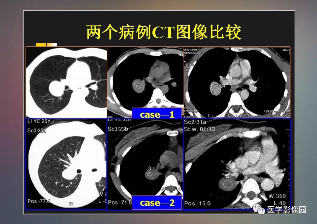 【PPT】右肺门区类圆形肿物的鉴别诊断—病例分析