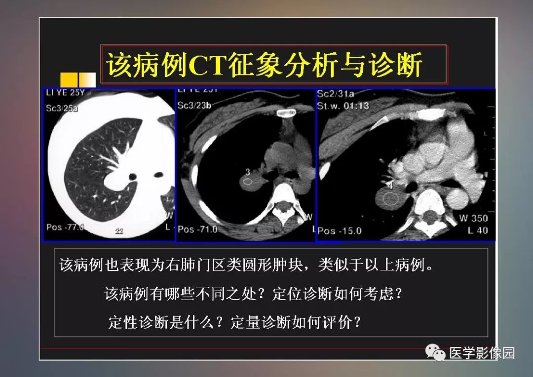【PPT】右肺门区类圆形肿物的鉴别诊断—病例分析
