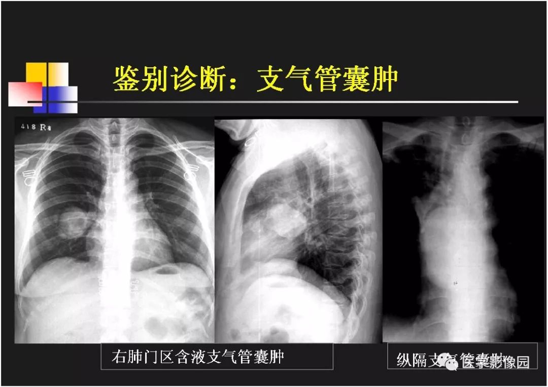 【PPT】右肺门区类圆形肿物的鉴别诊断—病例分析