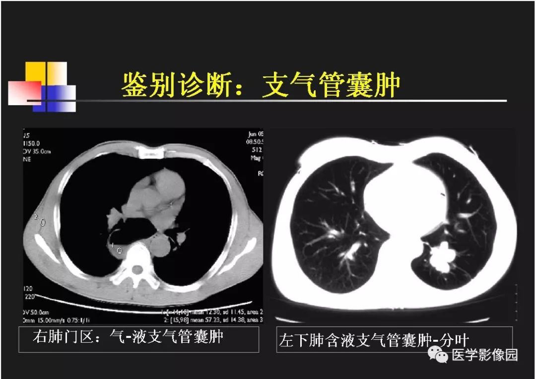 【PPT】右肺门区类圆形肿物的鉴别诊断—病例分析