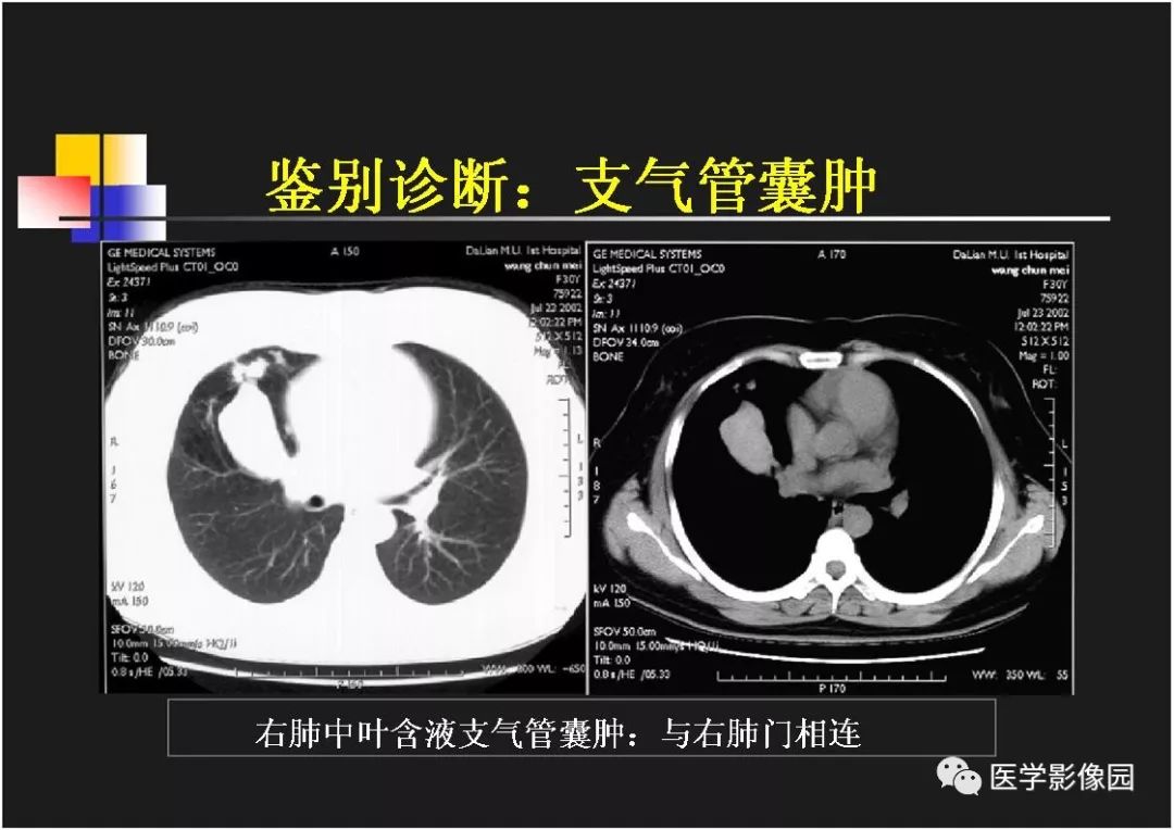 【PPT】右肺门区类圆形肿物的鉴别诊断—病例分析