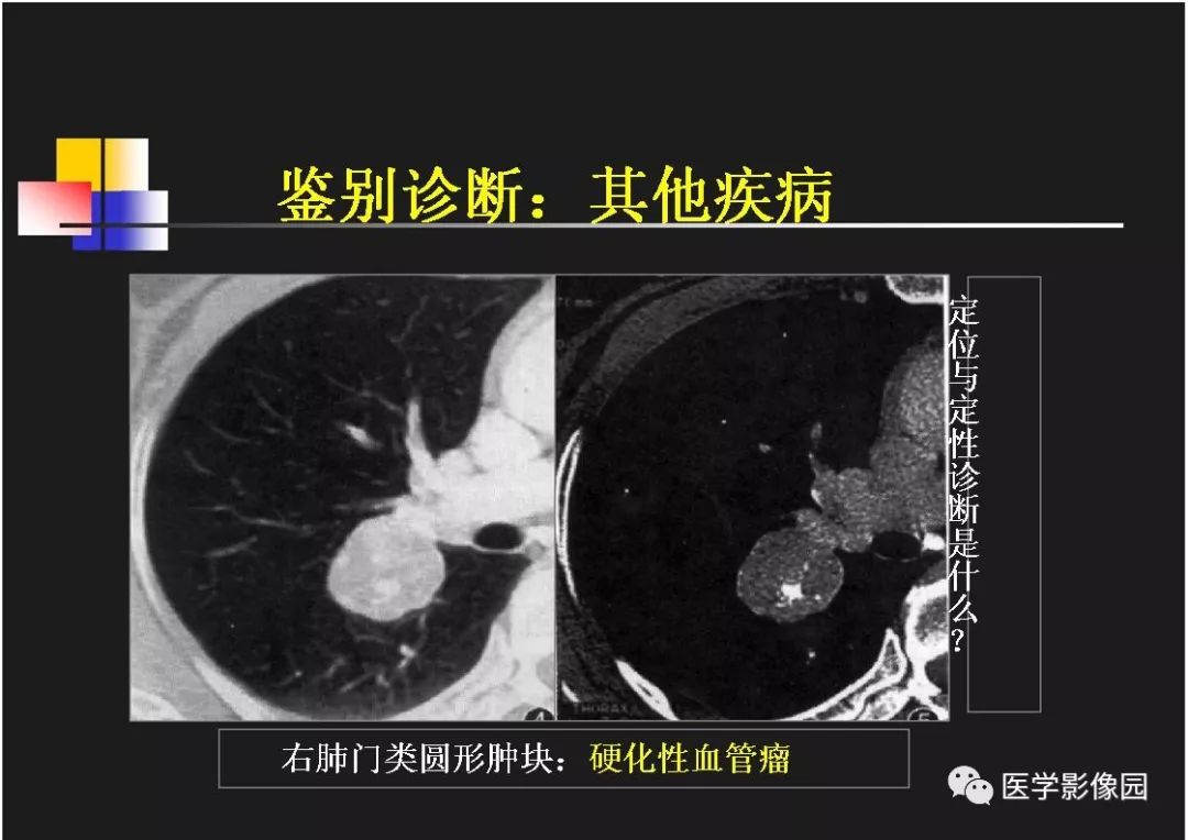 【PPT】右肺门区类圆形肿物的鉴别诊断—病例分析