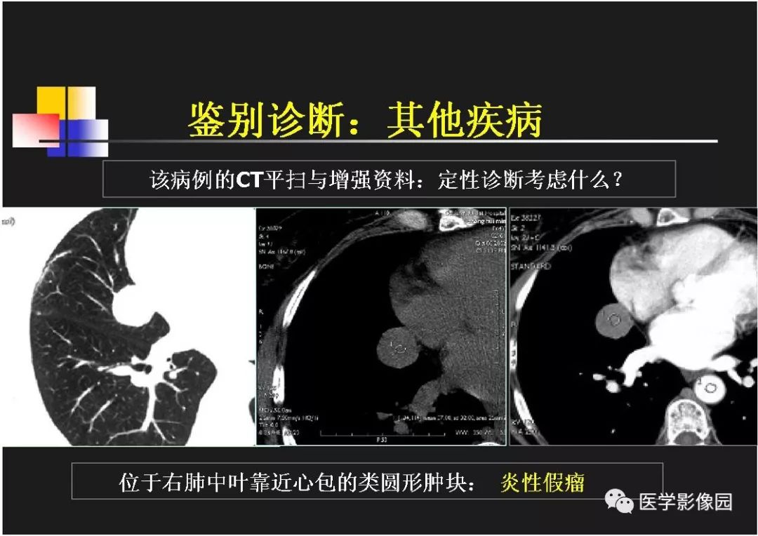 【PPT】右肺门区类圆形肿物的鉴别诊断—病例分析
