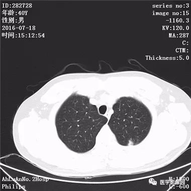 【病例】结核球1例CT影像表现 【病例】结核球1例CT影像表现