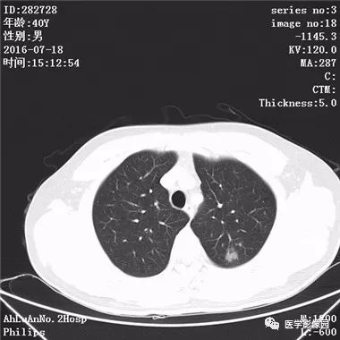 【病例】结核球1例CT影像表现 【病例】结核球1例CT影像表现