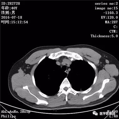 【病例】结核球1例CT影像表现 【病例】结核球1例CT影像表现