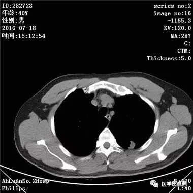 【病例】结核球1例CT影像表现 【病例】结核球1例CT影像表现