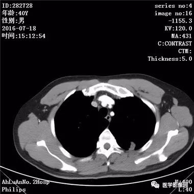 【病例】结核球1例CT影像表现 【病例】结核球1例CT影像表现