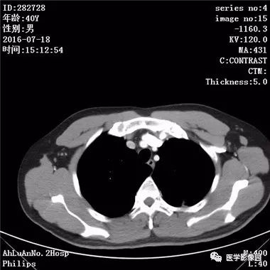 【病例】结核球1例CT影像表现 【病例】结核球1例CT影像表现