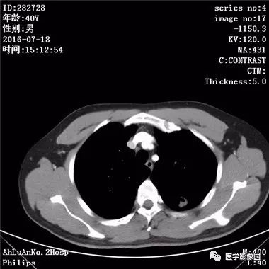 【病例】结核球1例CT影像表现 【病例】结核球1例CT影像表现