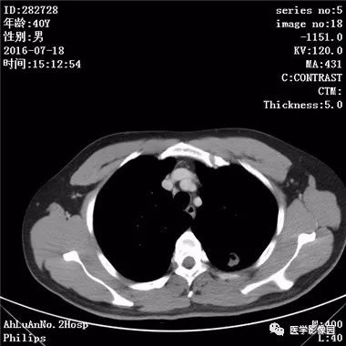 【病例】结核球1例CT影像表现 【病例】结核球1例CT影像表现