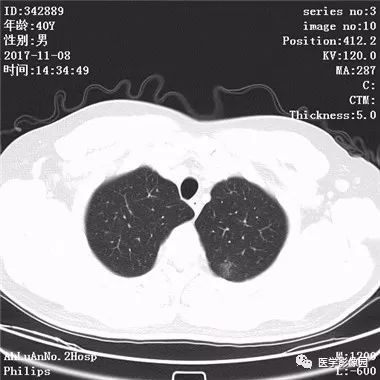 【病例】结核球1例CT影像表现 【病例】结核球1例CT影像表现