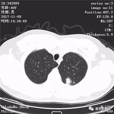 【病例】结核球1例CT影像表现 【病例】结核球1例CT影像表现