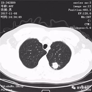 【病例】结核球1例CT影像表现 【病例】结核球1例CT影像表现
