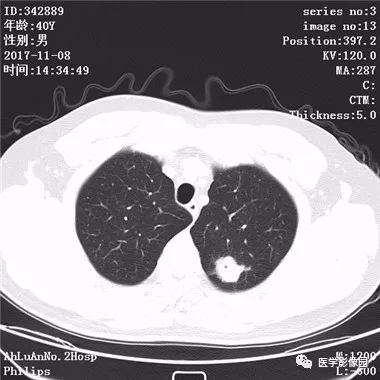 【病例】结核球1例CT影像表现 【病例】结核球1例CT影像表现