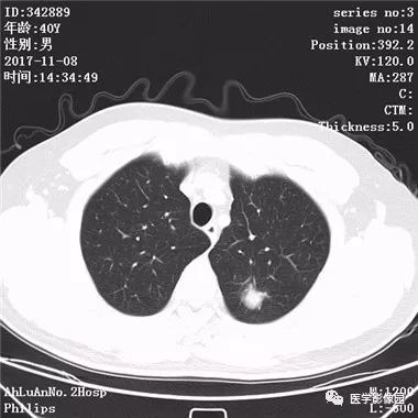 【病例】结核球1例CT影像表现 【病例】结核球1例CT影像表现