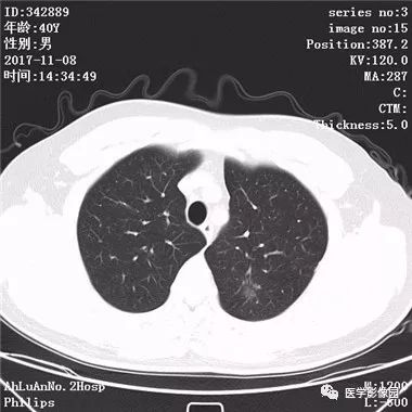 【病例】结核球1例CT影像表现 【病例】结核球1例CT影像表现