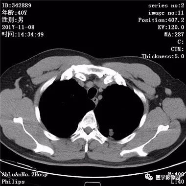 【病例】结核球1例CT影像表现 【病例】结核球1例CT影像表现