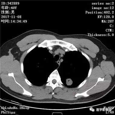 【病例】结核球1例CT影像表现 【病例】结核球1例CT影像表现