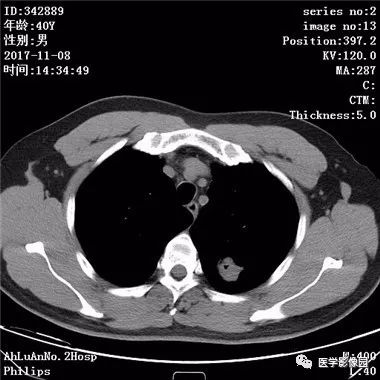 【病例】结核球1例CT影像表现 【病例】结核球1例CT影像表现