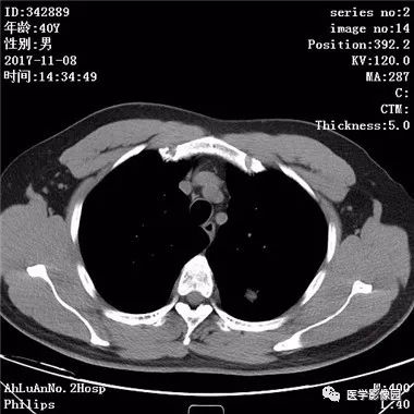 【病例】结核球1例CT影像表现 【病例】结核球1例CT影像表现