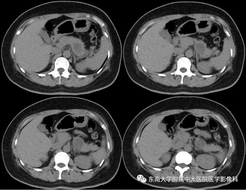 【病例】胰腺黏液性囊腺瘤1例CT影像表现