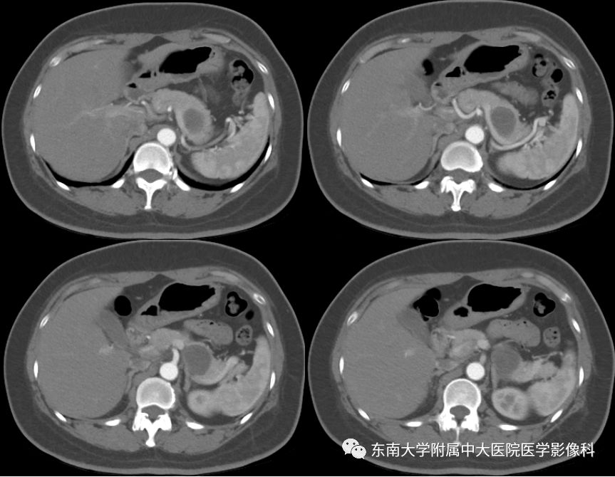 【病例】胰腺黏液性囊腺瘤1例CT影像表现