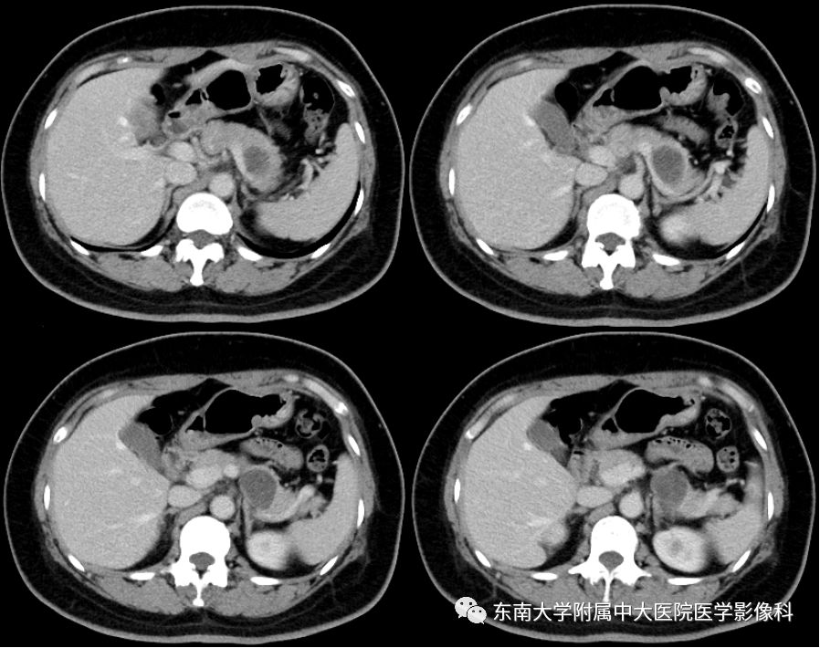 【病例】胰腺黏液性囊腺瘤1例CT影像表现