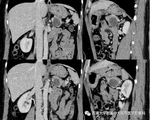 【病例】胰腺黏液性囊腺瘤1例CT影像表现