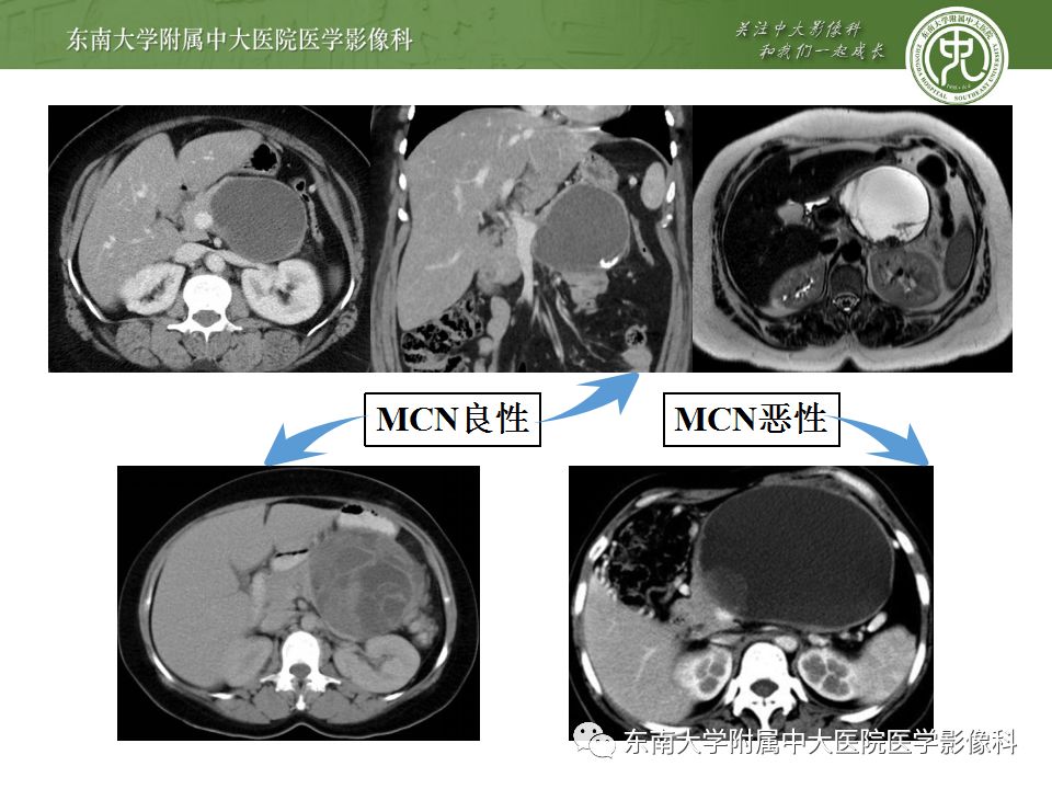 【病例】胰腺黏液性囊腺瘤1例CT影像表现