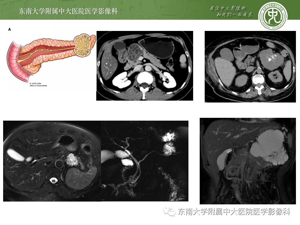 【病例】胰腺黏液性囊腺瘤1例CT影像表现