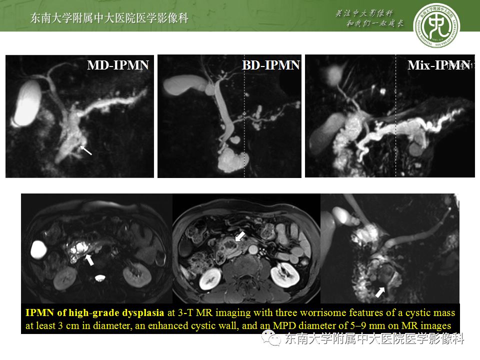 【病例】胰腺黏液性囊腺瘤1例CT影像表现