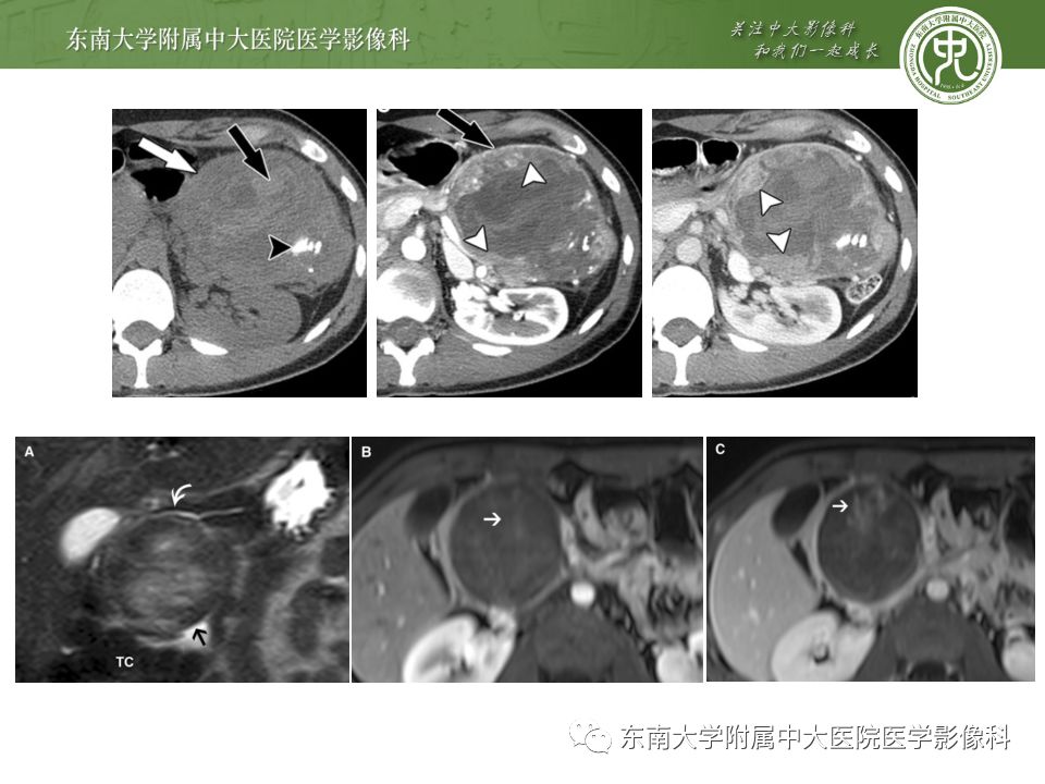 【病例】胰腺黏液性囊腺瘤1例CT影像表现