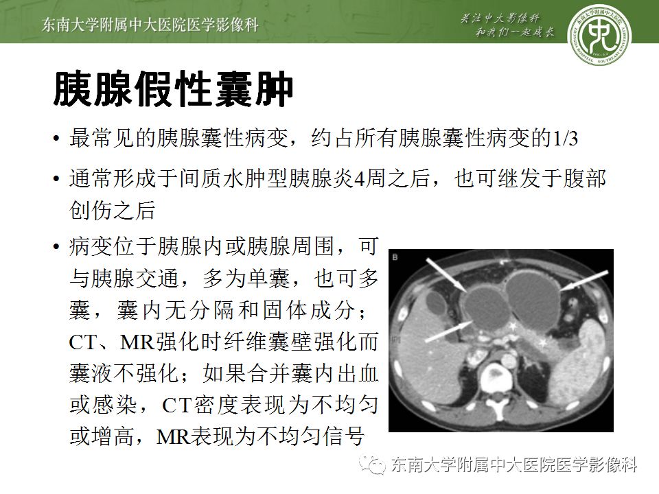 【病例】胰腺黏液性囊腺瘤1例CT影像表现