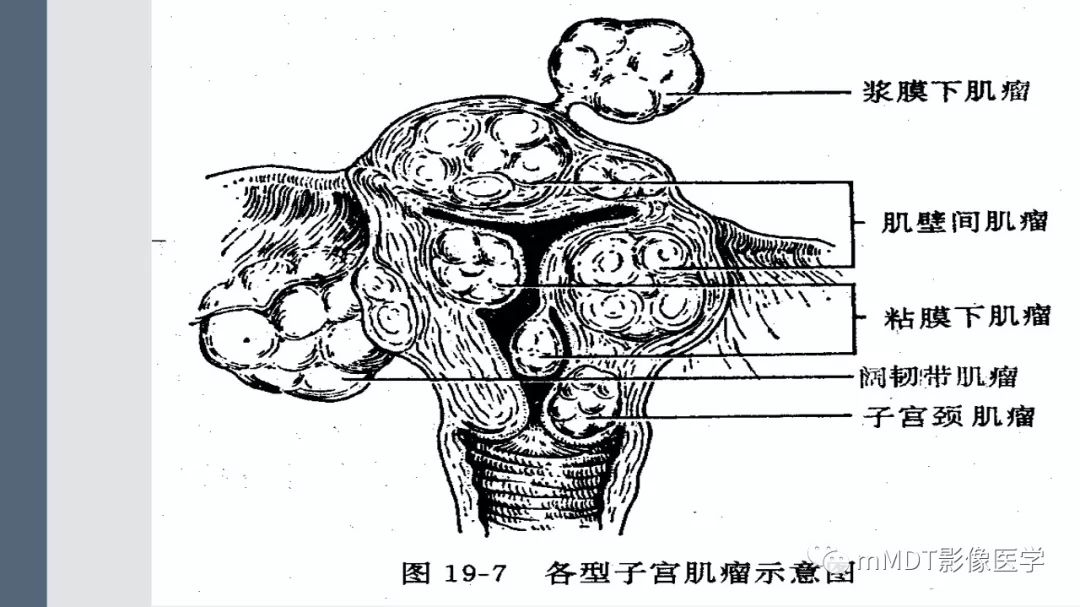 【PPT】子宫平滑肌瘤(子宫肌瘤)影像诊断