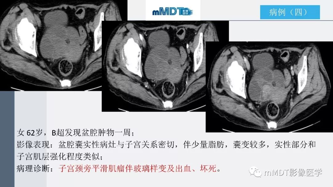 【PPT】子宫平滑肌瘤(子宫肌瘤)影像诊断